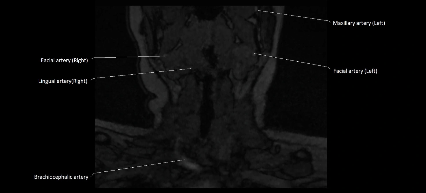 MRA carotid artery anatomy cross sectional 3T coronal image 1.webp